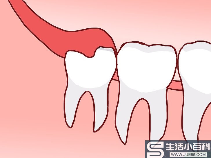 如何区分萌生智齿和阻生智齿