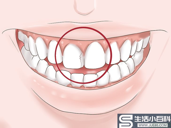 3种方法来判断自己的补牙材料是否需要更换
