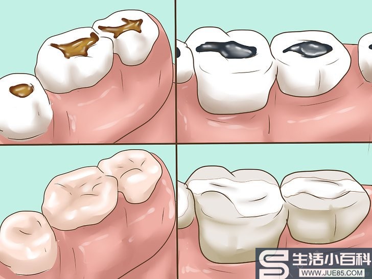 3种方法来判断自己的补牙材料是否需要更换