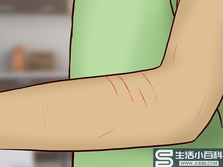 5种方法来处理猫抓伤
