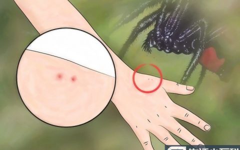 7种方法教你识别常见的毒蜘蛛咬伤