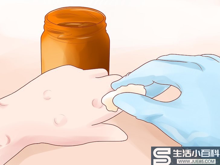 4种方法来自己在家治疗水痘