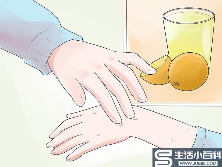 4种方法来自己在家治疗水痘