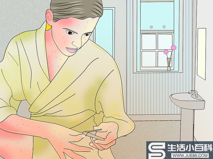 如何缓解水痘引起的瘙痒: 11 步骤