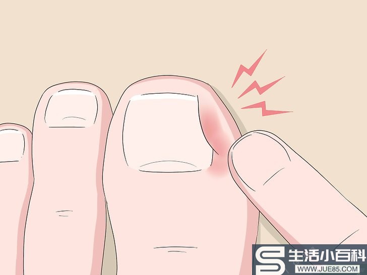 5种方法来缓解嵌趾痛