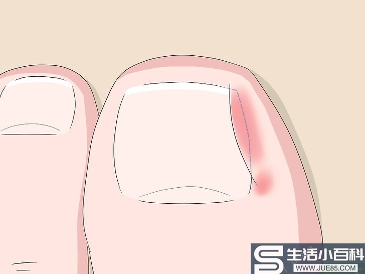 5种方法来缓解嵌趾痛