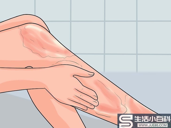 如何治疗被热水烫伤的皮肤
