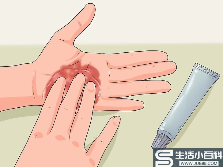 4种方法来治疗手烧伤