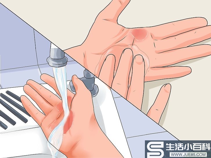 4种方法来治疗手烧伤