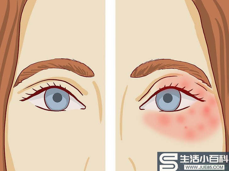 如何治疗眼部周围的湿疹（包含图片）