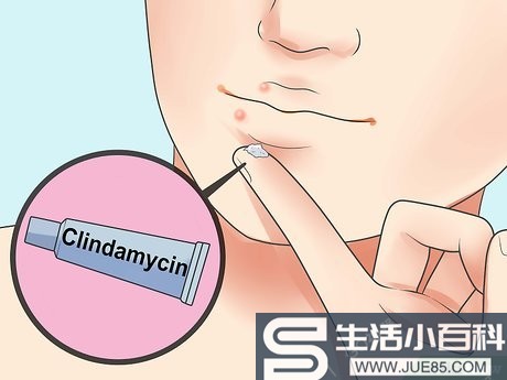 3种方法来快速治愈唇边的粉刺