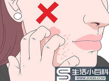 3种方法来去除脸上的皮疹